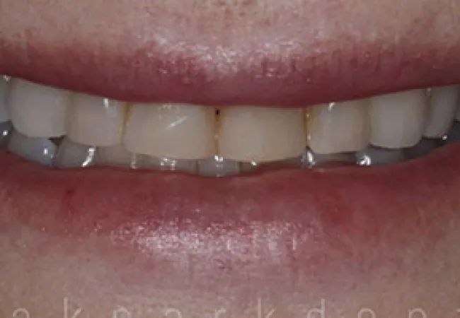 Close-up of a person's mouth showing teeth with some discoloration and slight gaps between teeth.