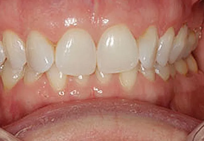 Close-up of human teeth showing gum health and alignment with partially open mouth and visible dental row
