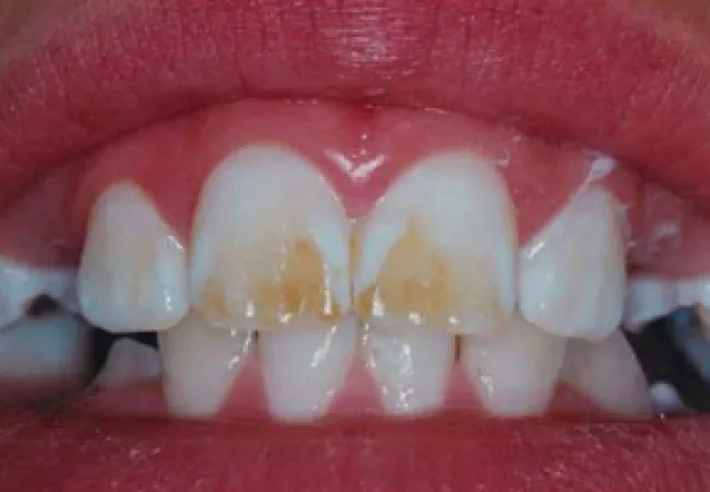 Close-up of teeth with visible brown stains and dental decay on front upper teeth and gums.
