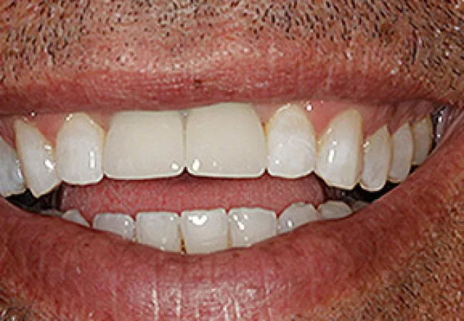 Close-up of an adult male smiling showing teeth with natural texture and facial hair details.