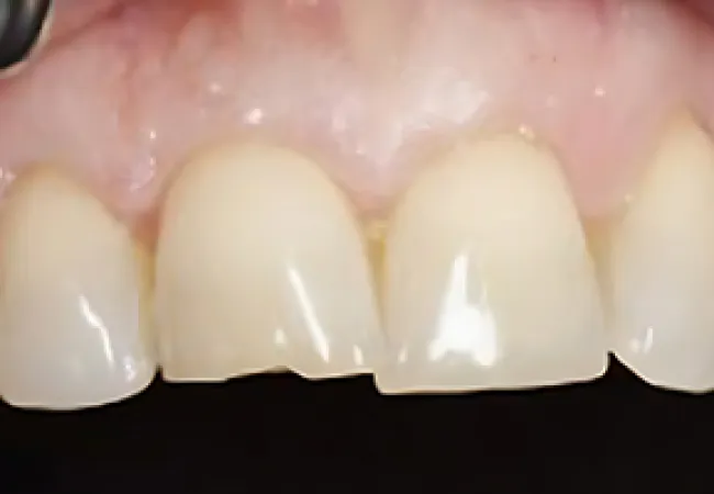Close-up of upper front teeth with a chipped central incisor displaying dental damage.