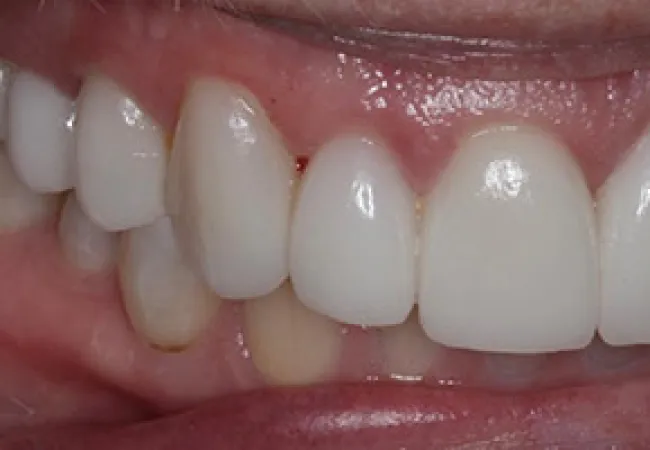 Close-up of healthy white teeth and pink gums showing dental alignment and oral hygiene.