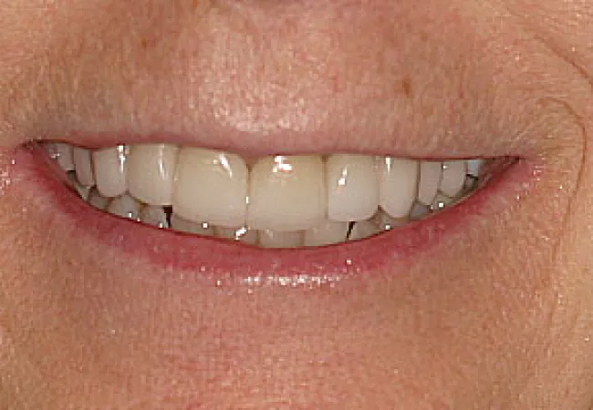 Close-up of a smiling mouth showing clean, white teeth with natural skin texture around lips.