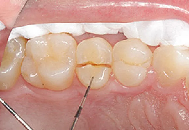 Close-up of a cracked molar tooth with dental tools inserted, showing dental cavity treatment.