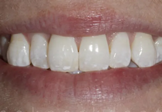Close-up of a smile showing teeth with white spots and natural gum details.