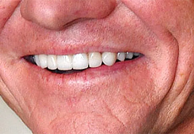 Close-up of a smiling mouth showing white teeth and natural skin wrinkles around lips and cheeks.