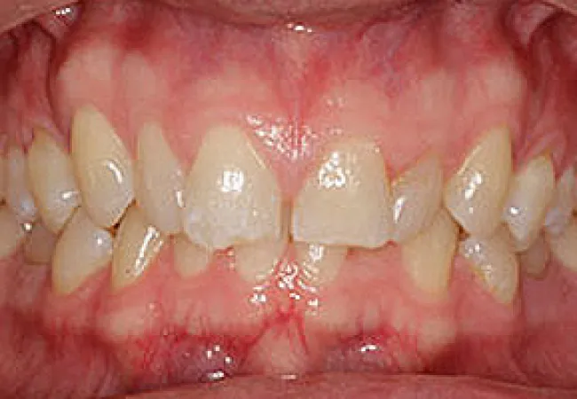 Close-up of misaligned and crowded upper and lower teeth with visible gums and dental irregularities.