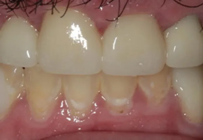 Close-up of lower front teeth showing gum recession and plaque buildup on teeth surfaces.
