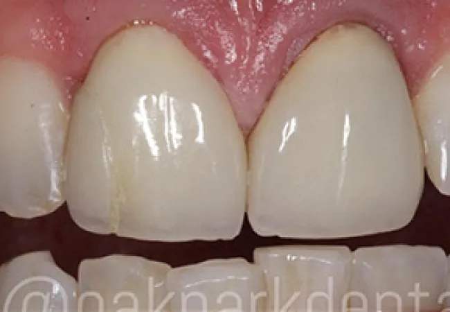 Close-up of upper and lower front teeth with visible chipping and slight discoloration on two upper front teeth.