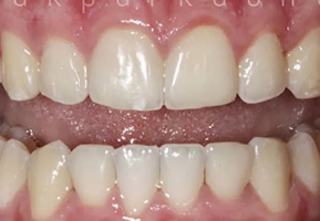 Close-up of upper and lower human teeth showing natural alignment and gum texture in healthy mouth.