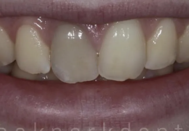 Close-up of a smile showing upper front teeth with discoloration and irregular shapes.