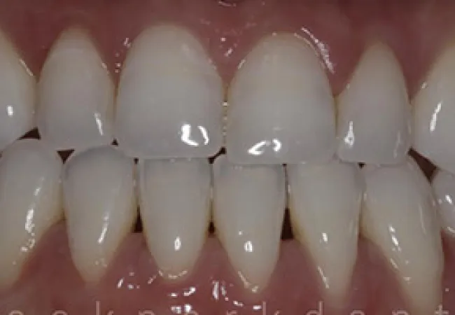 Close-up of clean, white human teeth with healthy gums and no visible dental issues.
