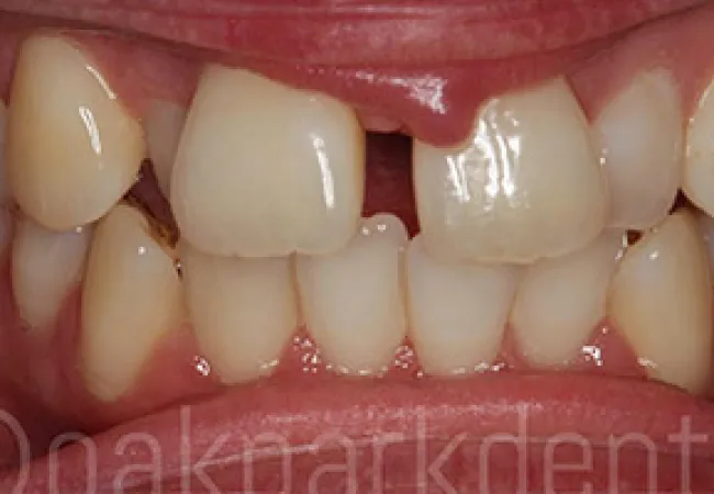 Close-up of a mouth showing crooked and missing teeth with dental issues.