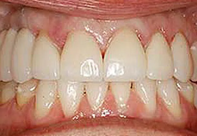 Close-up of human teeth showing dental crowns and natural teeth with healthy gums and slight discoloration.