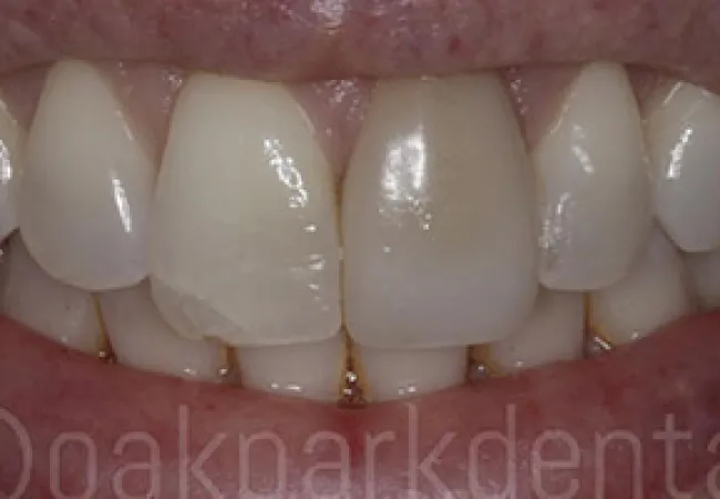 Close-up of a smile showing natural teeth with slight discoloration and plaque buildup near gums.