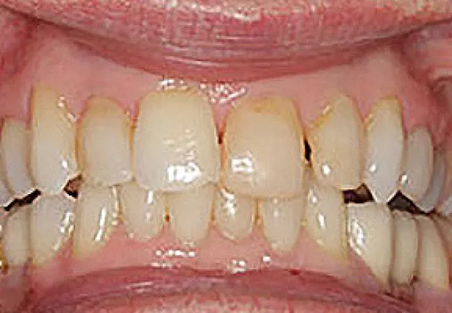 Close-up of teeth with visible plaque buildup and discoloration on gums and enamel.
