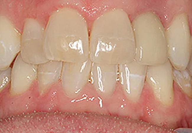 Close-up view of human teeth showing mild crowding and gum health in natural lighting.