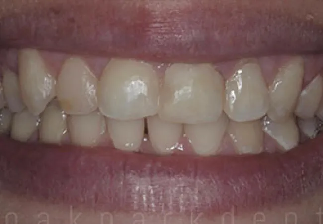 Close-up of a person's smile showing natural teeth with slight discoloration and minor gaps between teeth.