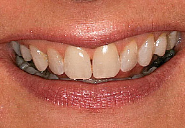 Close-up of a person smiling showing natural teeth with gaps and healthy lips.