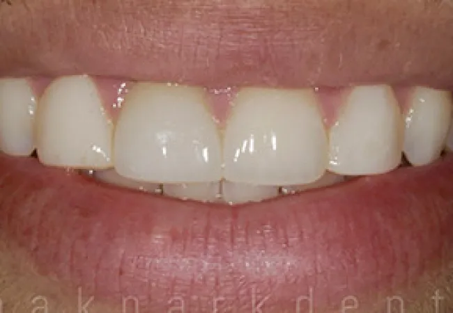 Close-up of a smiling mouth showing clean, straight white teeth and healthy pink gums.