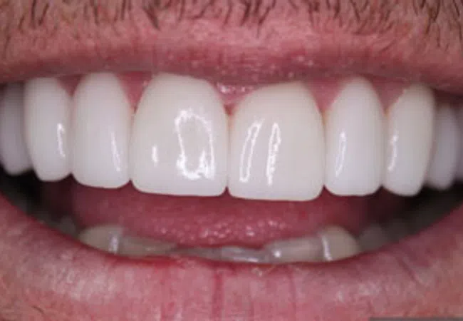Close-up of a smiling mouth showing clean, white, even teeth with healthy gums and facial hair.