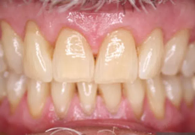 Close-up of a smile showing slightly yellowed teeth with minor crowding and visible gums.