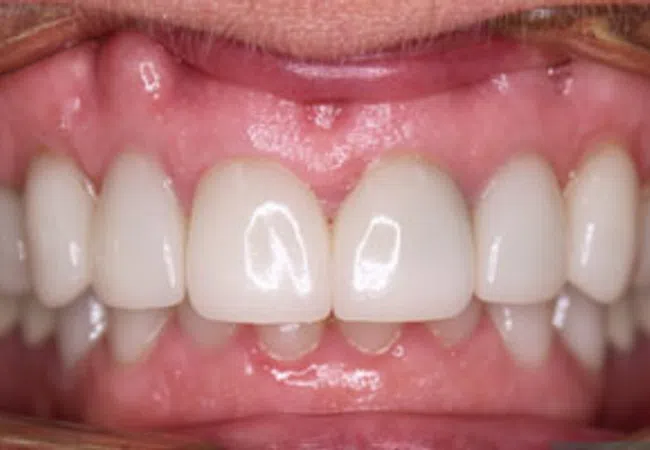 Smile Gallery - Close-up of a smiling woman showcasing bright, healthy teeth and smooth lips.
