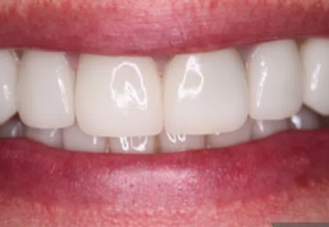 Close-up of a bright smile showing clean, white, perfectly aligned teeth and healthy lips.