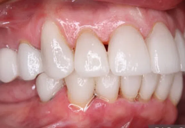 Close-up of healthy white teeth and gums showing dental alignment and oral hygiene.