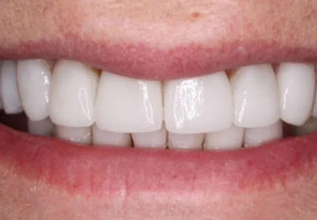 Close-up of a smiling mouth showing clean, straight, white teeth and natural pink lips.