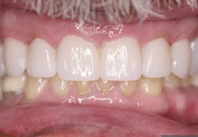 Close-up of upper dental crowns on natural lower teeth, highlighting dental restoration and oral health balance.