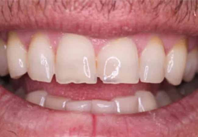 Close-up of a smile showing natural teeth with slight discoloration and a small chip on a front tooth.