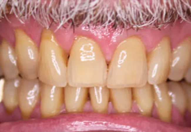 Close-up of aged yellowed teeth with gaps and visible dental plaque on upper and lower gums.