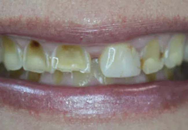 Close-up of a smile showing severely decayed, yellowed, and damaged teeth with visible cavities and stains.