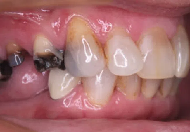 Close-up of teeth with severe dental decay and cavities on upper and lower molars and incisors.