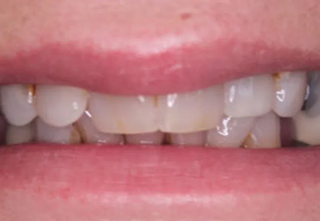 Close-up of a mouth showing uneven, discolored teeth with visible dental issues and some missing teeth.