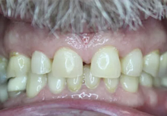Close-up of uneven, yellowed teeth with gaps and dental irregularities under a mustache.