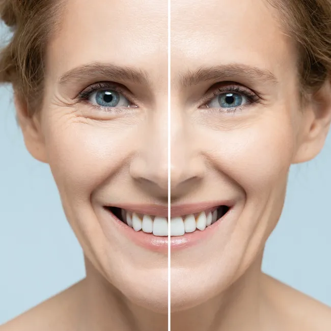 Split image of a smiling woman showing facial skin before and after anti-aging treatment with visible wrinkles and smooth skin.