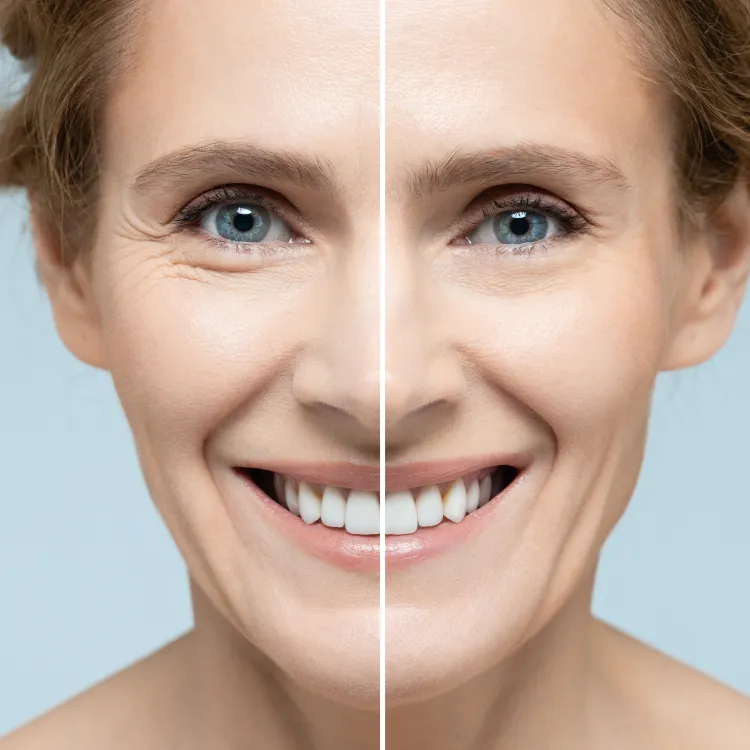 Split image of a smiling woman showing facial skin before and after anti-aging treatment with visible wrinkles and smooth skin.