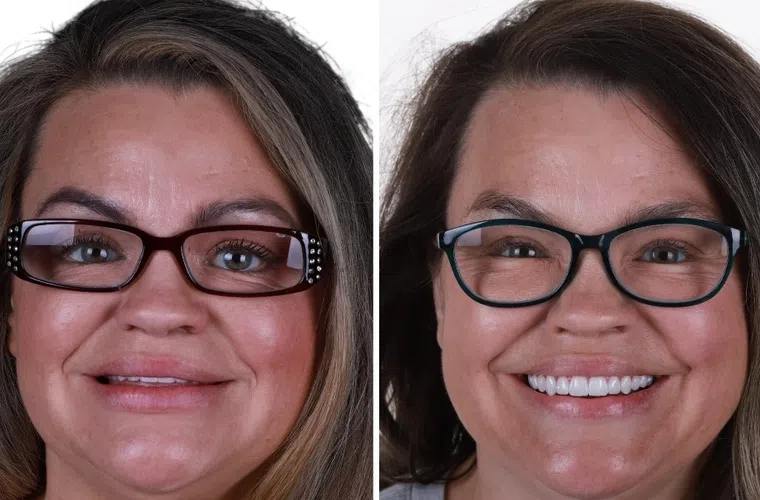 Before and after dental treatment showing improved teeth whitening and smile enhancement on a woman wearing glasses.