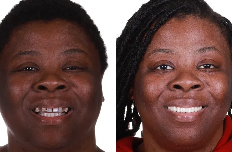 Before and after dental restoration showing a woman with improved smile and teeth.