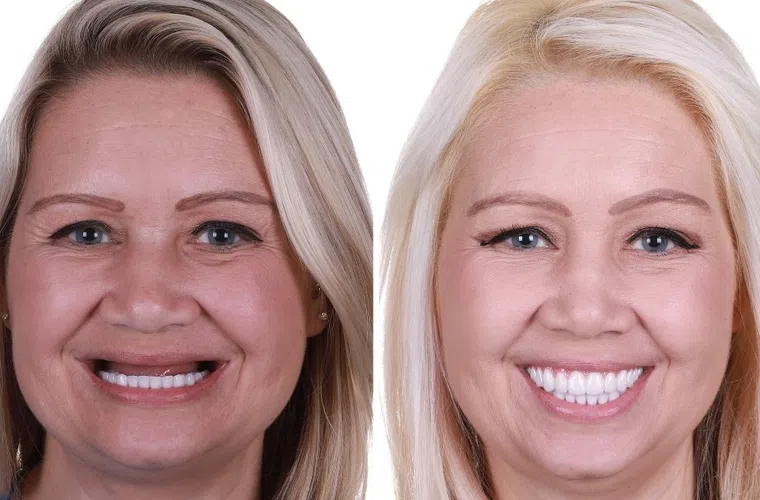 Before and after dental implants showing a woman’s smile transformation with new white teeth and natural results.