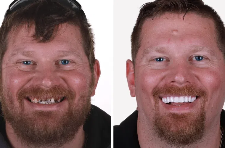 Before and after photos showing dental transformation with damaged teeth replaced by bright white veneers.