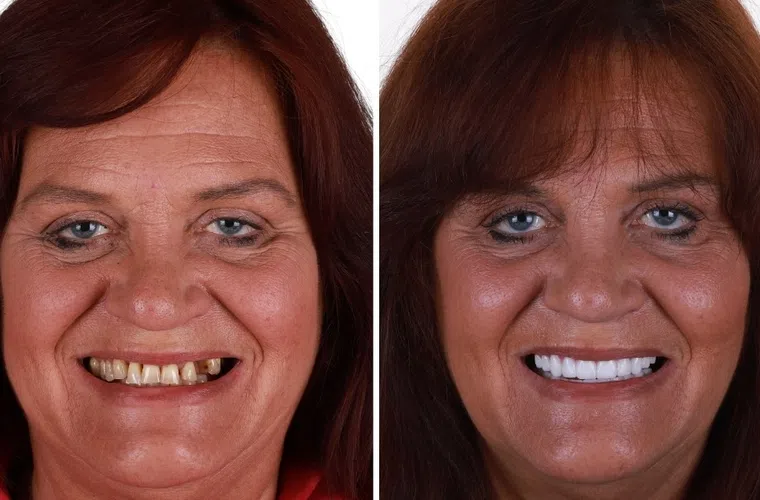 Before and after dental transformation showing a woman with discolored, misaligned teeth and then bright, straight white teeth.