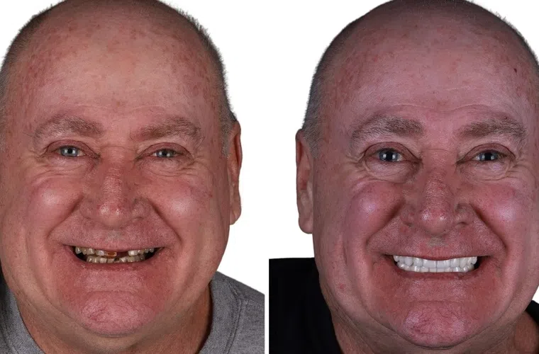 Before and after dental restoration showing a man's damaged teeth transformed into a bright, healthy smile.