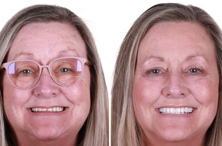 Before and after dental makeover showing improved smile and teeth whitening on a smiling woman.
