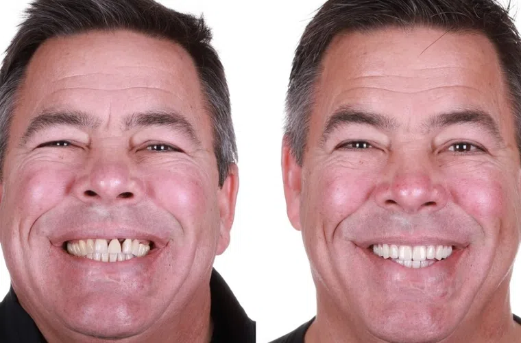Before and after dental treatment showing a man's smile transformation with improved white teeth and dental health.