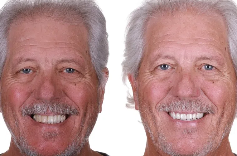 Before and after photos of an older man showing gum disease treatment and improved dental health with whiter teeth.