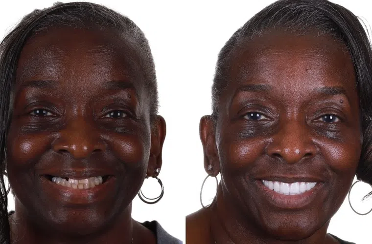 Before and after dental transformation of a woman showing improved smile and white teeth.