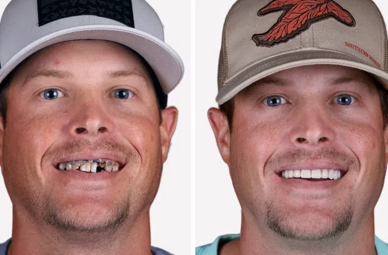 Before and after images of a man showing severe dental decay and a healthy white smile after dental restoration.